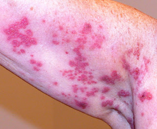 Treat Herpes Zoster Shingles : Herpes Indicators Is Every Closely Related To Other Std - Learn The Best Way To Differentiate Them