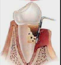 <Img src ="Dibujo-sondaje-periodontal.jpg" width = "188" height "200" border = "0" alt = "Dibujo de la medición de una bolsa periodontal.">