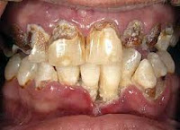 Pyorrhea ou parodontite se réfère à un stade avancé de la maladie parodontale dans lequel les ligaments et les os qui soutiennent les dents deviennent enflammées et infectées.