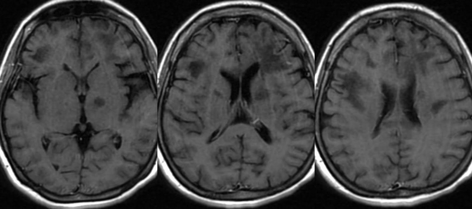 Brain Disease: White Matter Brain Disease