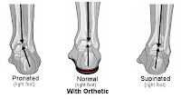 Now Orthotics - What Are They?