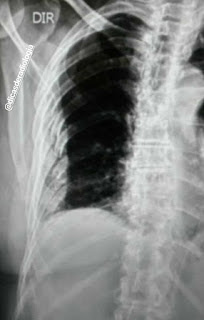 Exame de raio X mostrando costela quebrada