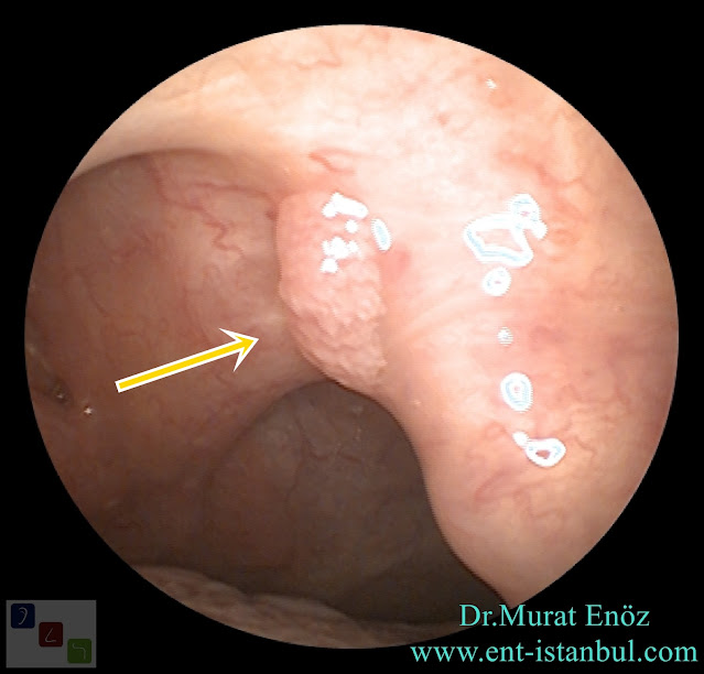 Papilloma of the Uvula