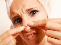 Cara Menghilangkan Bintik Bintik Hitam Di Hidung