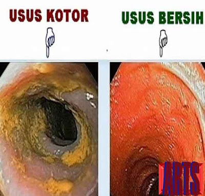 manfaat daun sirsak untuk Membersihkan bakteri jahat pada usus