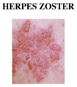 Penyakit Herpes Zoaster Pada Wanita