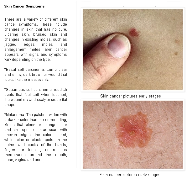 Skin cancer | Skin Cancer Advices