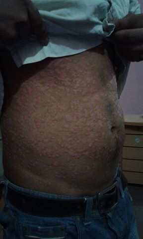 সোরিয়াসিস(psoriasis) রোগের চিকিৎসা