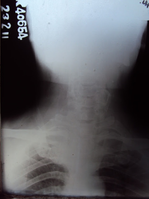 radiologi, penyinaran, foto rontgen, x-ray, posisi anatomi, ismus tiroid, isthmus tiroid, hipotiroidisme, struma nodosa nontoksik, struma noduler nontoksik, pemeriksaan penunjang, hipertiroidisme, CT scan, MRI, catscan, magnetic resonance imaging, antero posterior, costa, costa vera, scapula, clavicula, skapula, klavikula, tulang belikat, deltoid, sternokleidomastoideus, sternocleidomastoidea, muskulus, ligamen, ligamentum, situs colli, pendorongan trakea, lobus tiroid, trakhea