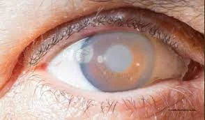 glaucoma signs and symptoms