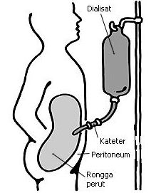 dialisa peritoneal