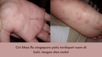 https://www.susistory.com/2023/12/pengalaman-terkena-flu-singapura.html
