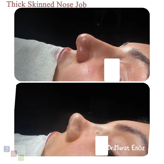 Thick Skinned Nose Job,  Istanbul plastic surgery,specialized surgeons,nasal enhancement,ethnic rhinoplasty experts.,Thick skinned nose,Istanbul ethnic rhinoplasty,cultural nose surgery Turkey,