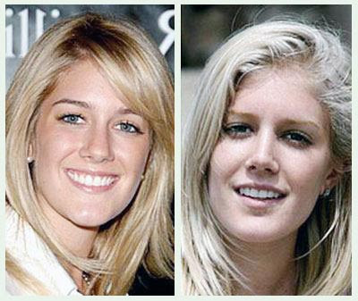 before and after nose jobs celebrity. Heidi Nose Job
