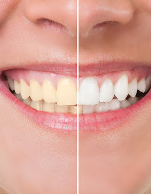 teeth Whitening Long Island