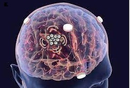 New 'AI sensor' to detect brain injury