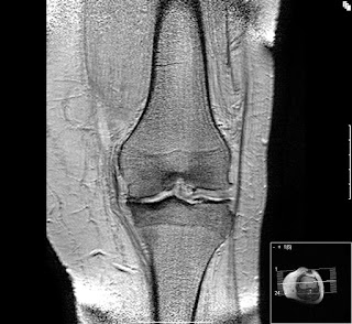 soulager-arthrose