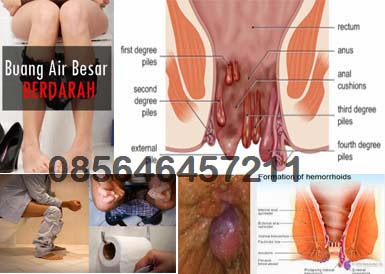 Obat Benjolan Nyeri Wasir (Hemoroid) Di Apotik