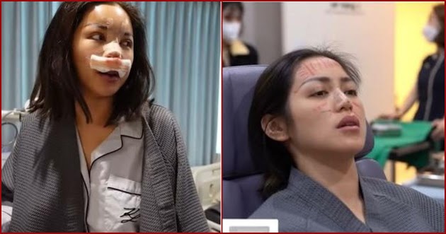 8 Potret Proses Jessica Iskandar Jalani Operasi Hidung di Korea, Bikin Pangling