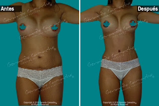 Abdominoplastia Colombia