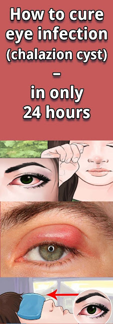 HOW TO CURE EYE INFECTION (CHALAZION CYST) – IN ONLY 24 HOURS