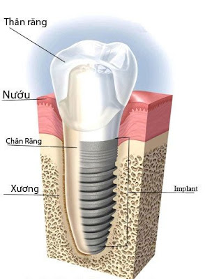 trong-rang-su-vinh-vien-la-gi