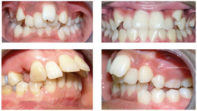 Những tác hại của răng khấp khểnh
