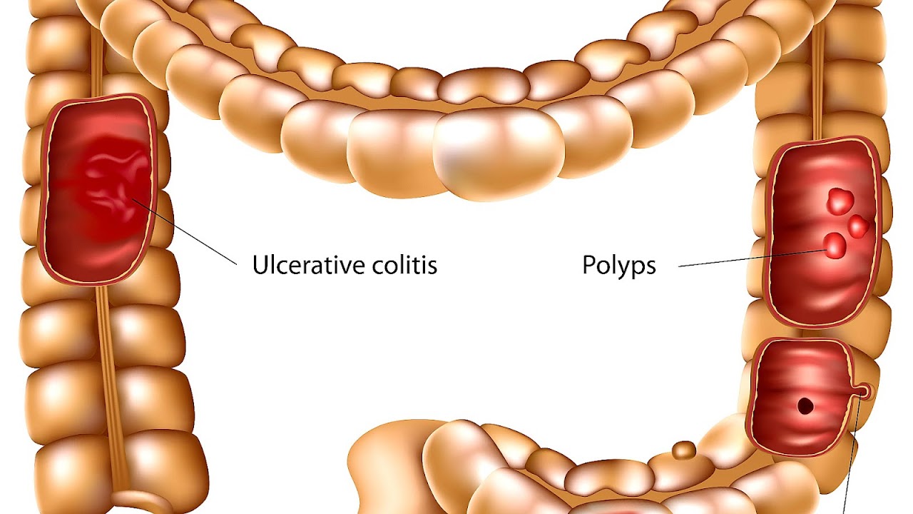 Constipation Ulcerative Colitis