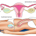Inseminasi Buatan: Membantu Kehamilan dengan Cara Khusus
