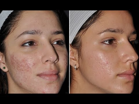 Acne Causes - 4 Common Misconceptions