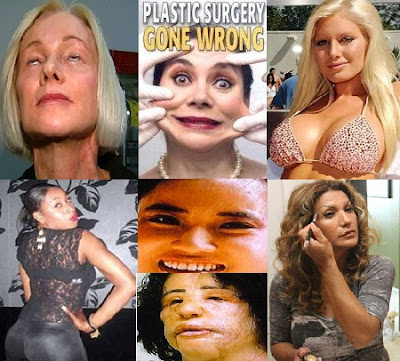 Worst Plastic Surgery Disasters