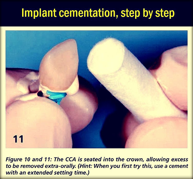 PDF: Implant Cementation, step by step 