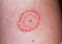 Daad-khaj-khujli-ringworm-home-treatment-home-remedies-fungal-infection-treatment-symptom-pictures-diagnosis-hindi