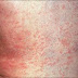 The causes and treatment of Roseola