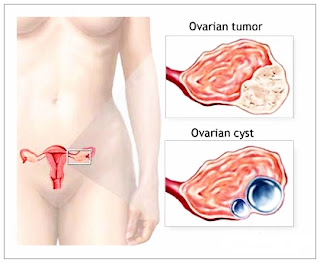 Pengobatan Herbal Tumor Ovarium Yang Aman Dan Alami