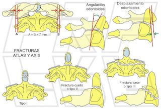 Fracturas del atlas y del axis.