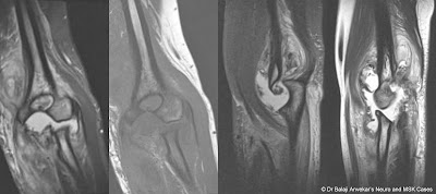 NEUROPATHIC%2BARTHROPATHY%2BMRI.jpg