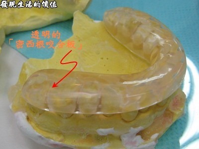 治療夜間磨牙的「密西根咬合板」