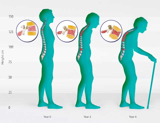 Penyakit Osteoporosis Pada Lansia