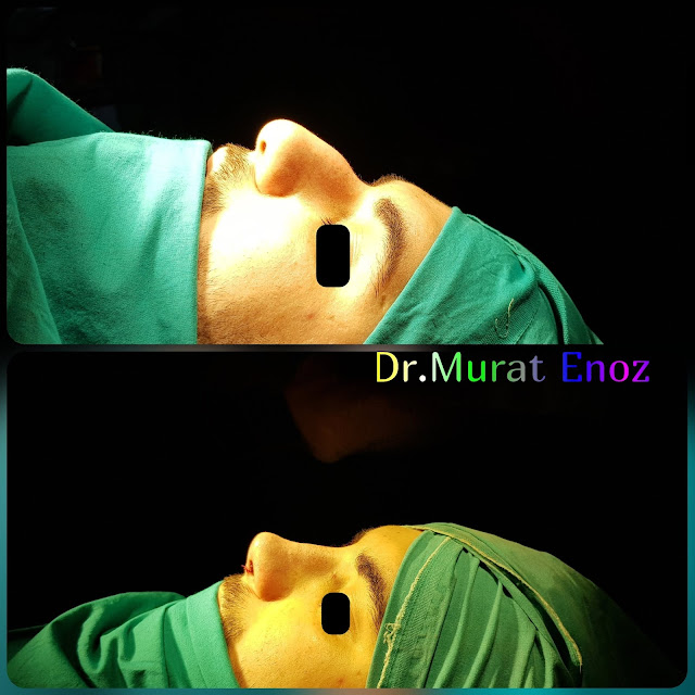 Rhinoplasty in men Istanbul, Male nose job Turkey. Nose aesthetic surgery for men