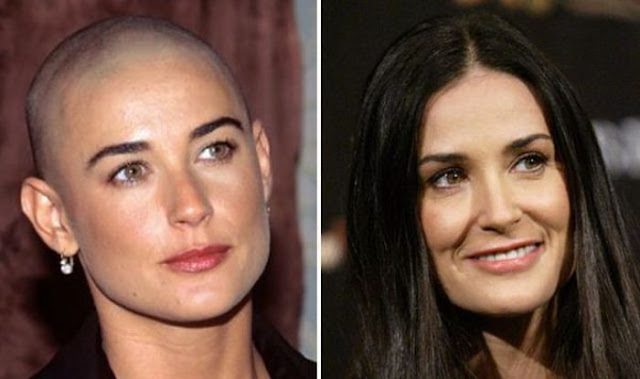 Celebrities Going Bald 