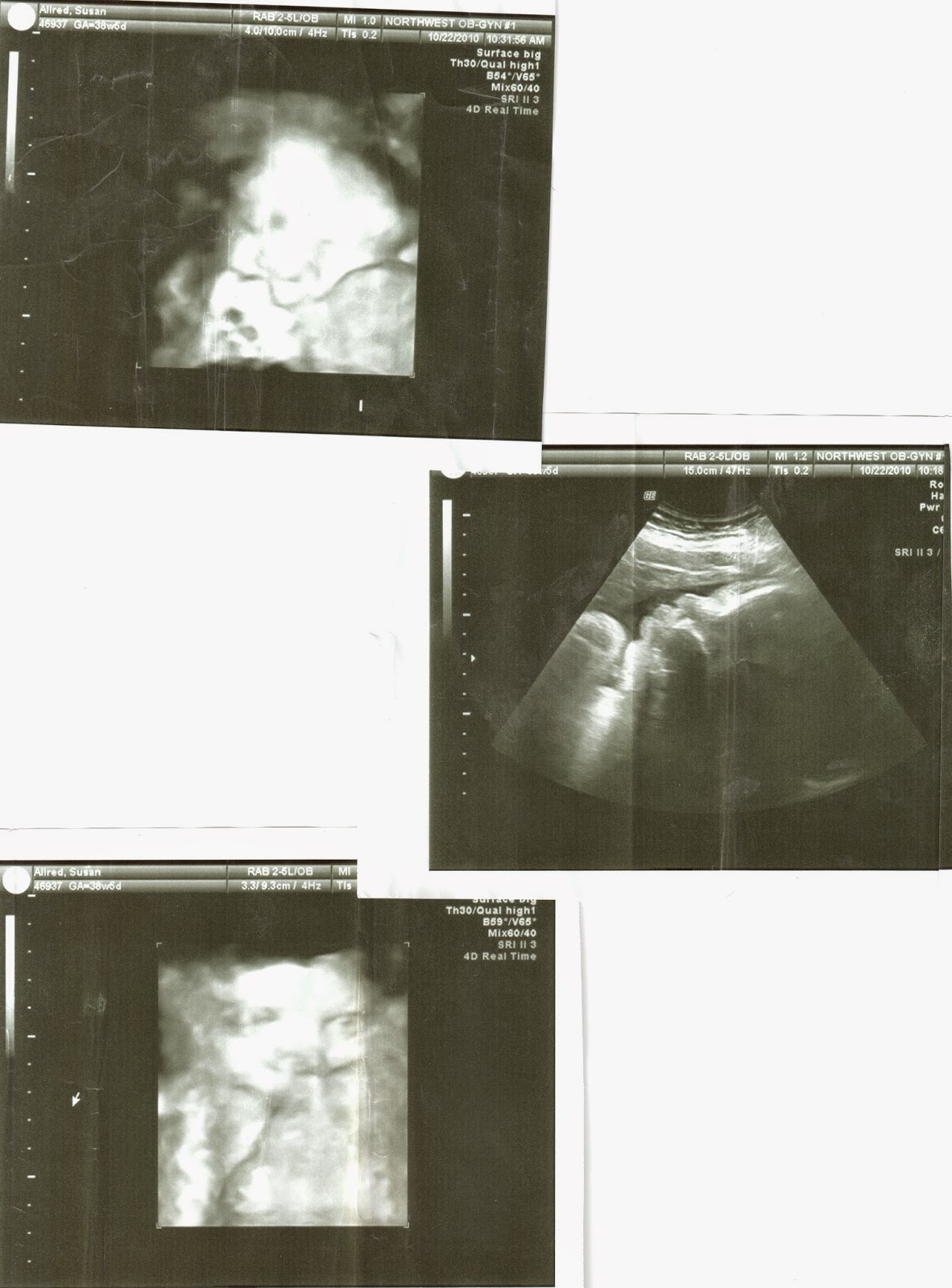 Jacob at 38 weeks gestation.  Jake has Down syndrome and a heart defect