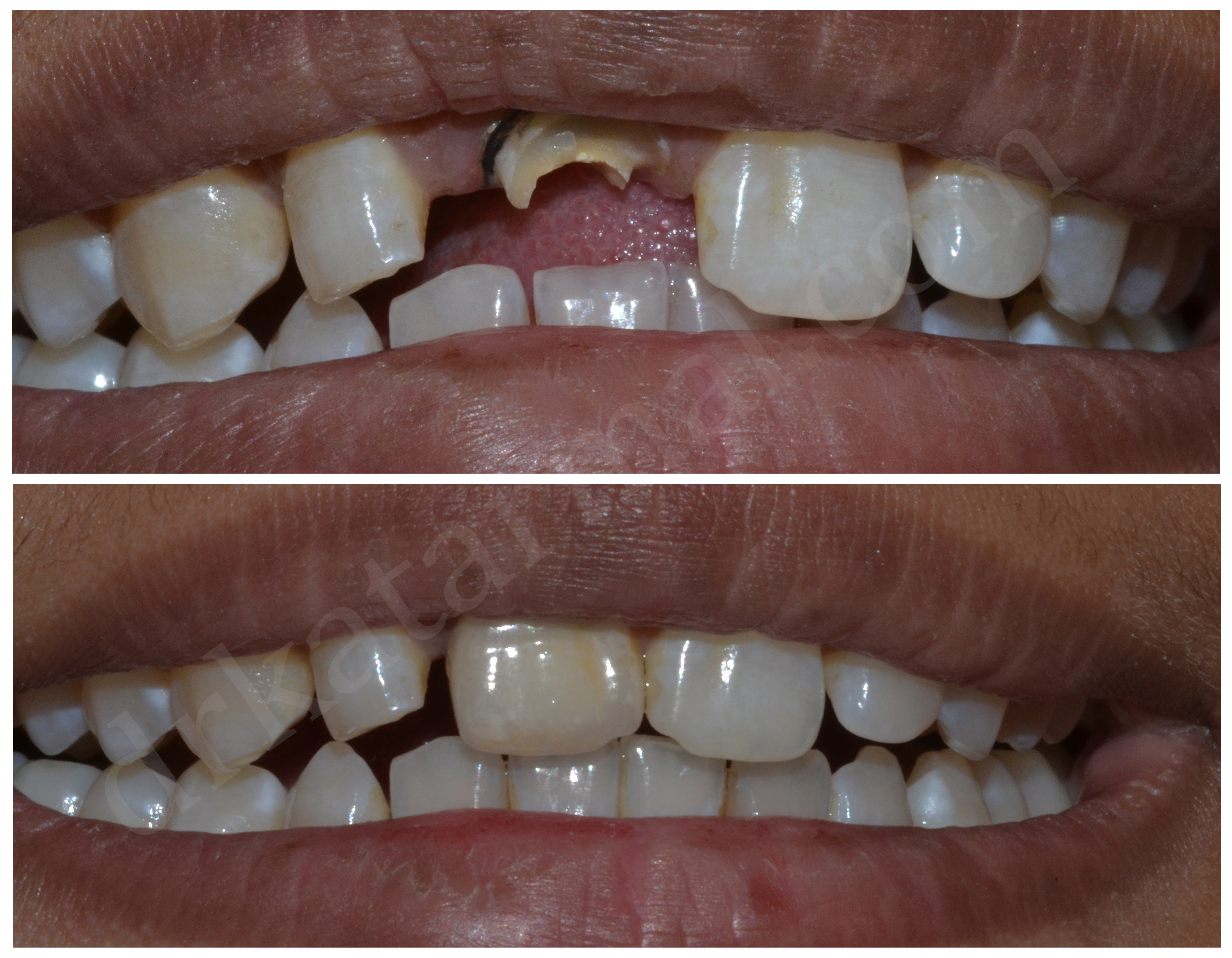 Broken Front Teeth Repair with Composit ~ Dr. Bharat Katarmal Dental &  Implant Clinic