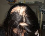 alopecia treatment Islamabad