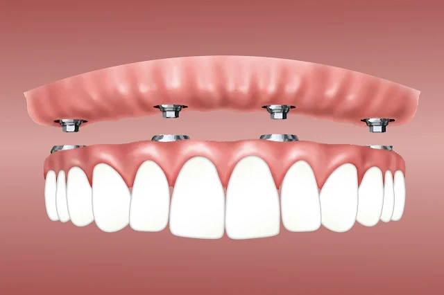 Dental Implants