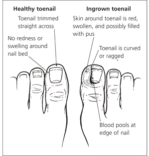 Ingrown toenail diagram.