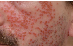 Eczema Herpeticum Skin Condition What Is It Treatment And Advice For Patient Dermatology Information Research