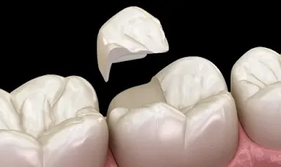 How to Fix a Cracked Tooth Naturally? Best way to fix a cracked