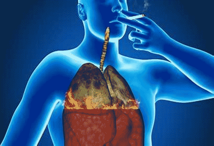 How does lung cancer affect those who do not smoke? Symptoms and Treatment, Thiruvananthapuram, News, Health and Fitness, Lung Cancer, Treatment, Doctors, Patient, Warning, Kerala