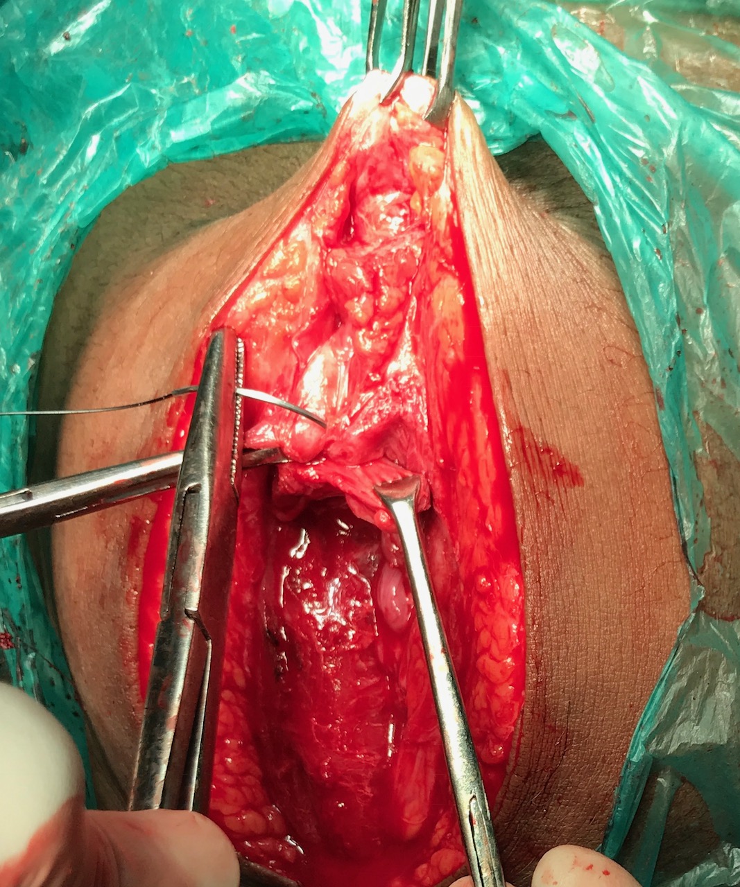 Simultaneous prosthetic mesh abdominal wall reconstruction with